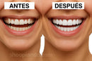 Carillas dentales - Descubre el poder de una sonrisa blanca - OFERTA 3X1